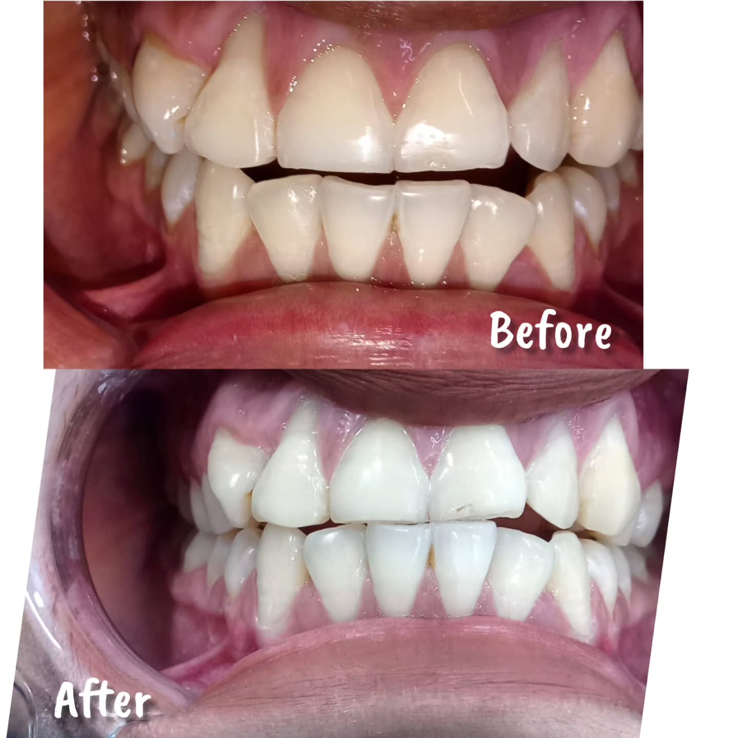 Dental Restoration