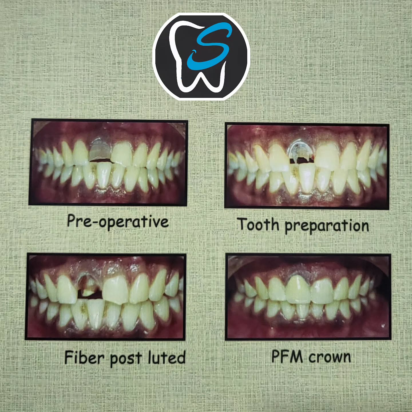 Teeth Whitening