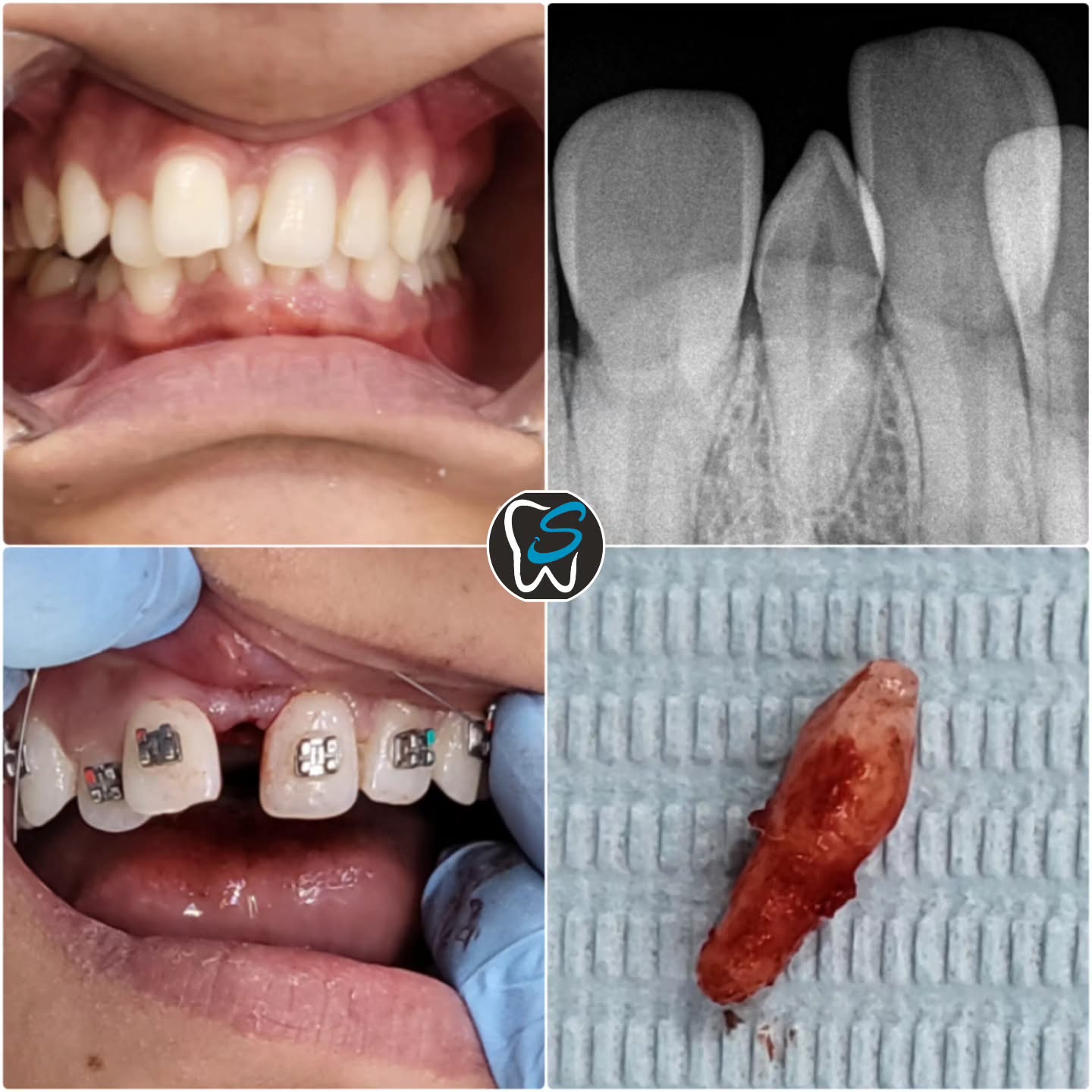 Root Canal Treatment